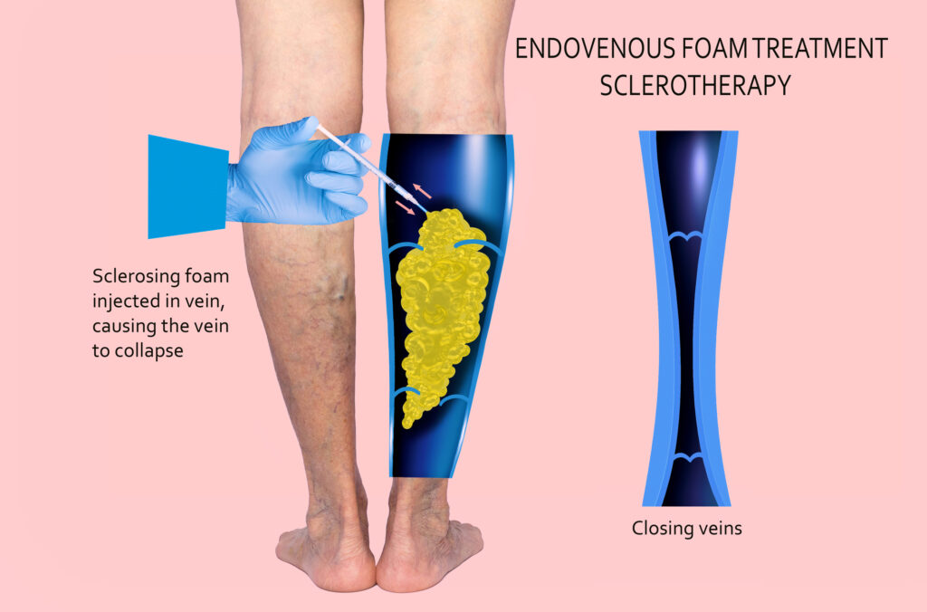 Image showing a comparison of a leg undergoing endovenous foam treatment sclerotherapy. On the left, a leg with varicose veins is injected with sclerosing foam. On the right, an illustration depicts the foam causing the vein to collapse and close.