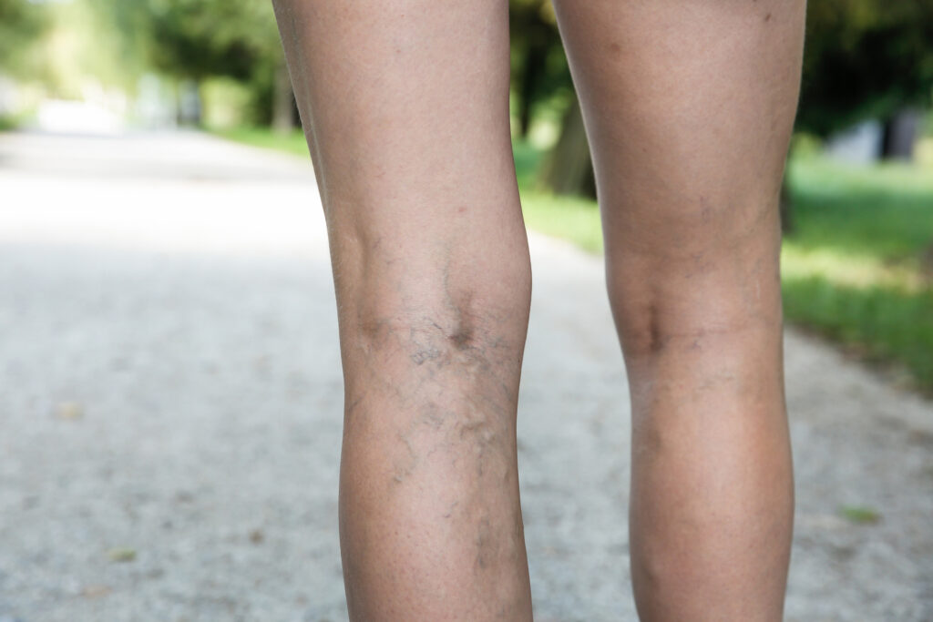Person with visible varicose veins in their leg