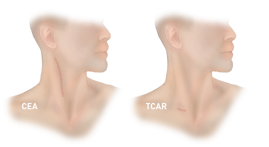 Illustration comparing CEA and TCAR: two neck profiles with different incision markings on the skin, labeled accordingly.