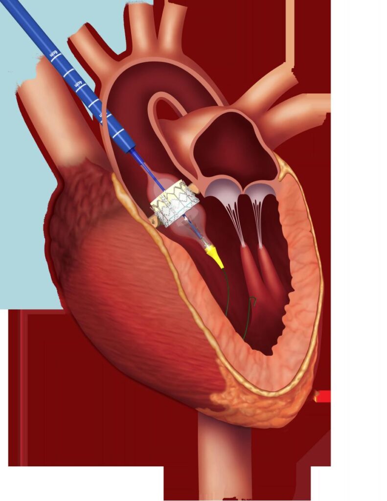 Illustration of a heart with a catheter inserting a stent-like device into a valve, demonstrating a transcatheter aortic valve replacement.